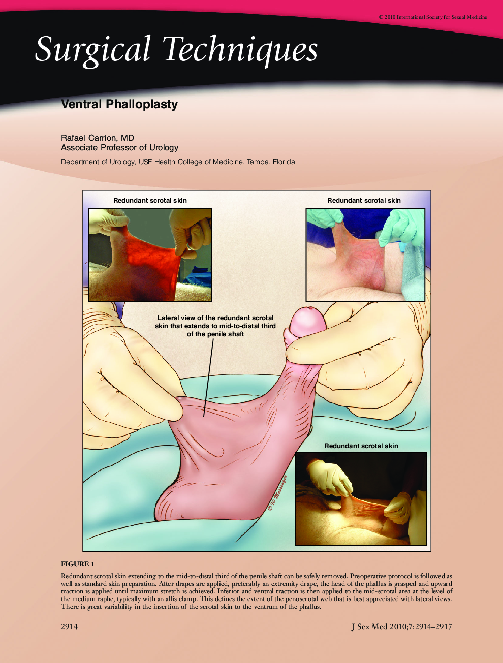Ventral Phalloplasty