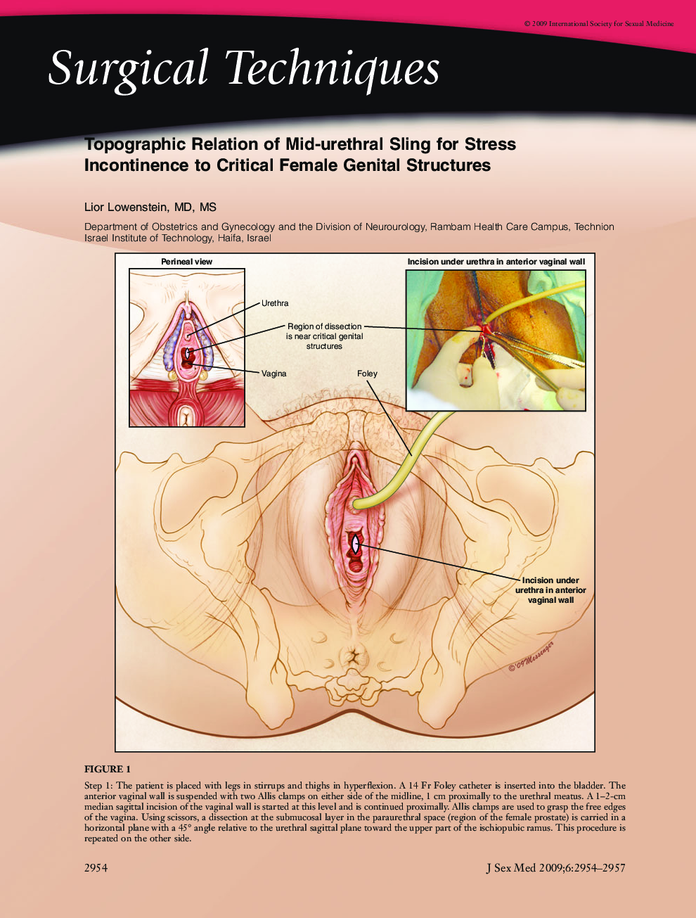 Surgical Techniques: Topographic Relation of Midâurethral Sling for Stress Incontinence to Critical Female Genital Structures