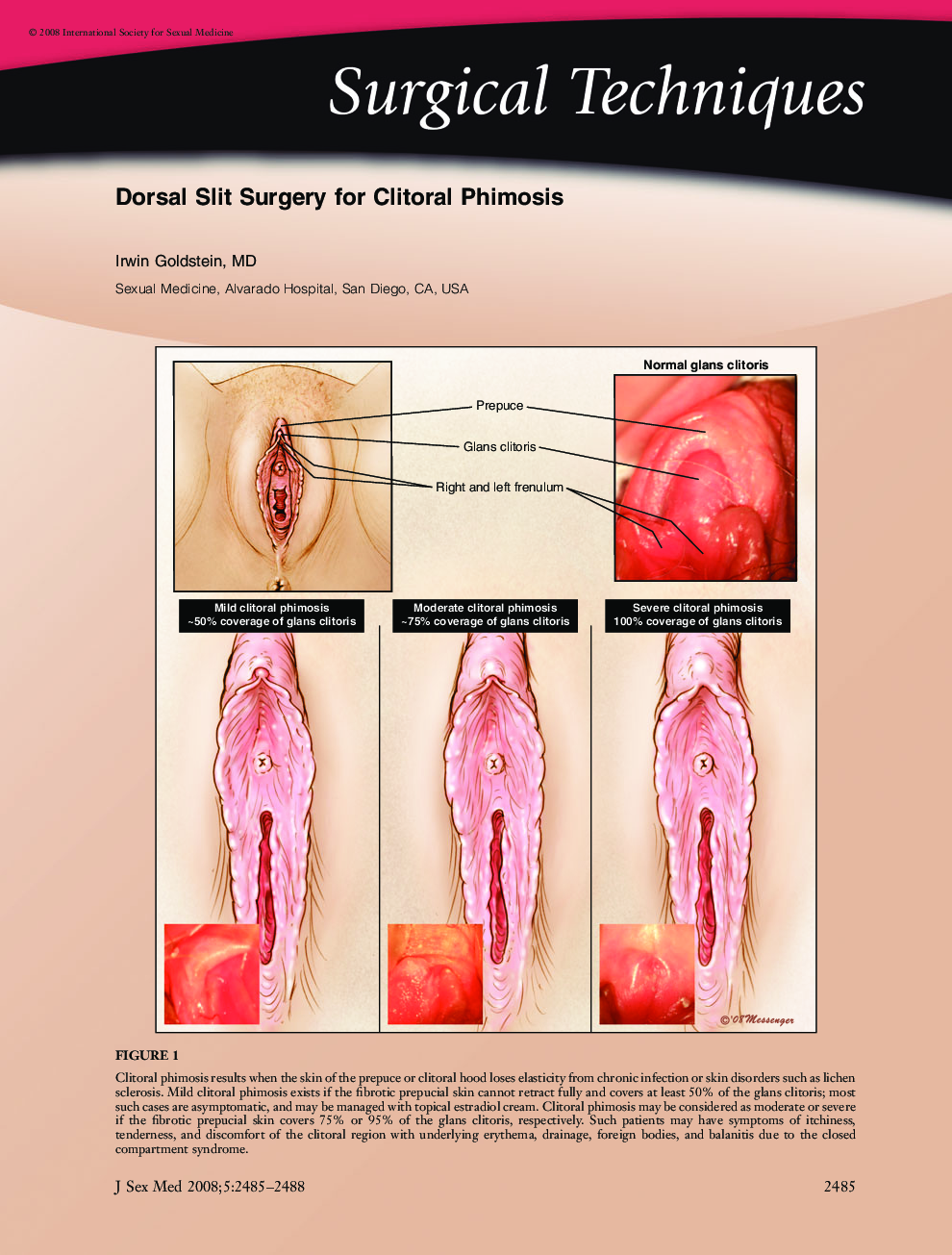 Surgical Techniques: Dorsal Slit Surgery for Clitoral Phimosis