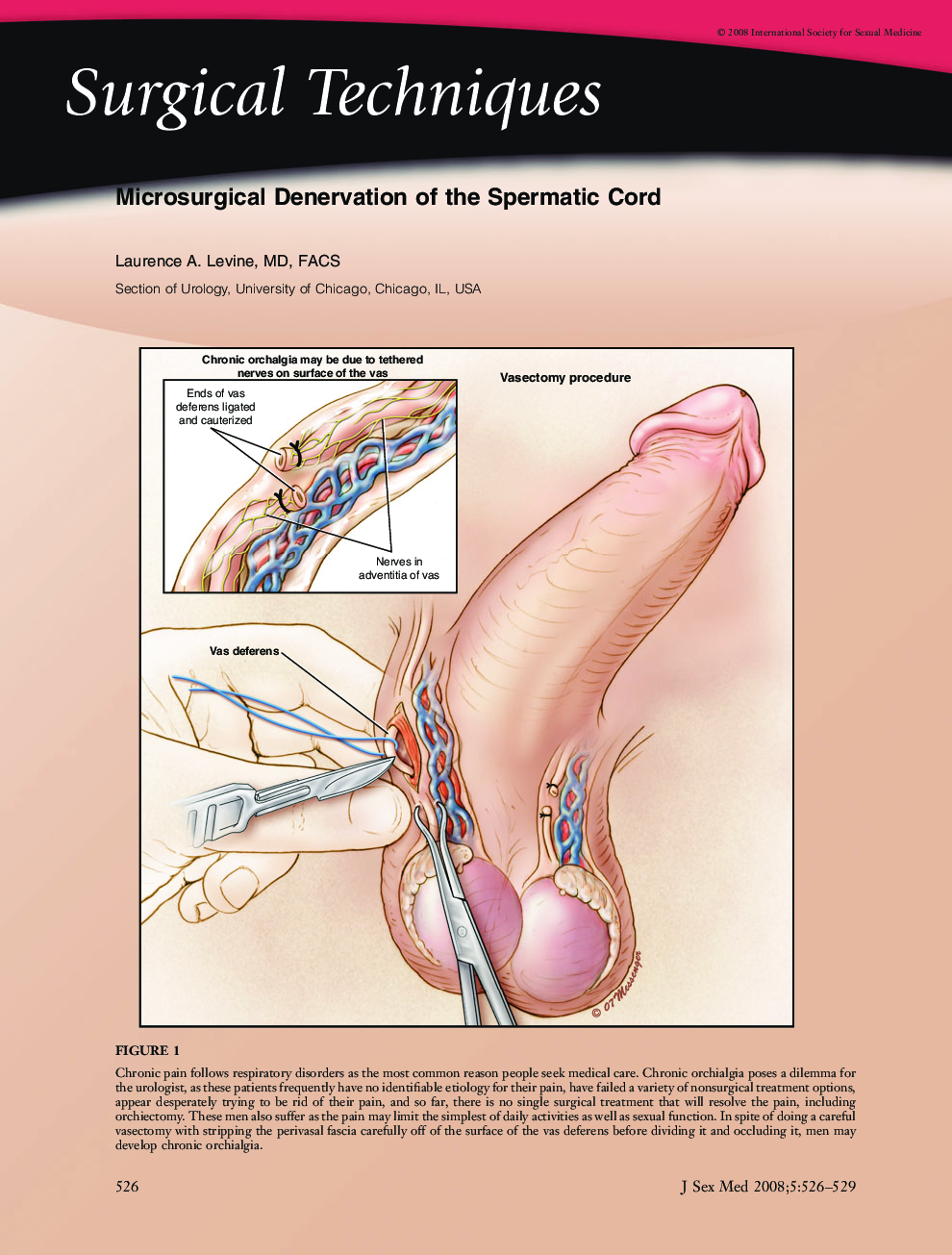 Surgical Techniques: Microsurgical Denervation of the Spermatic Cord