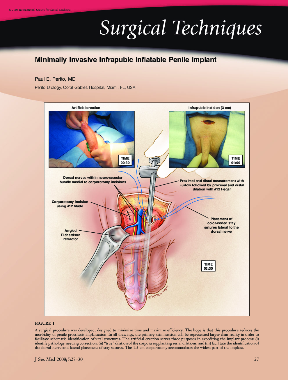 Surgical Techniques: Minimally Invasive Infrapubic Inflatable Penile Implant
