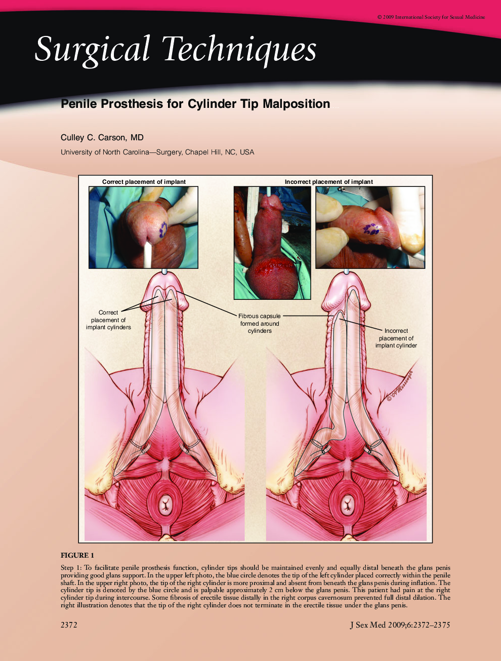 Surgical Techniques: Penile Prosthesis for Cylinder Tip Malposition