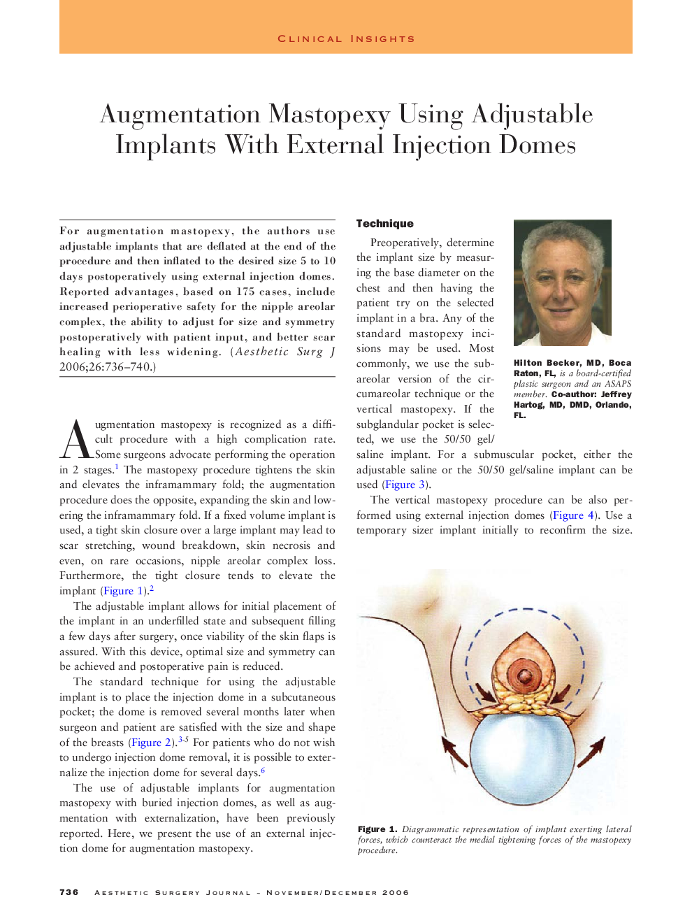 Augmentation mastopexy using adjustable implants with external injection domes