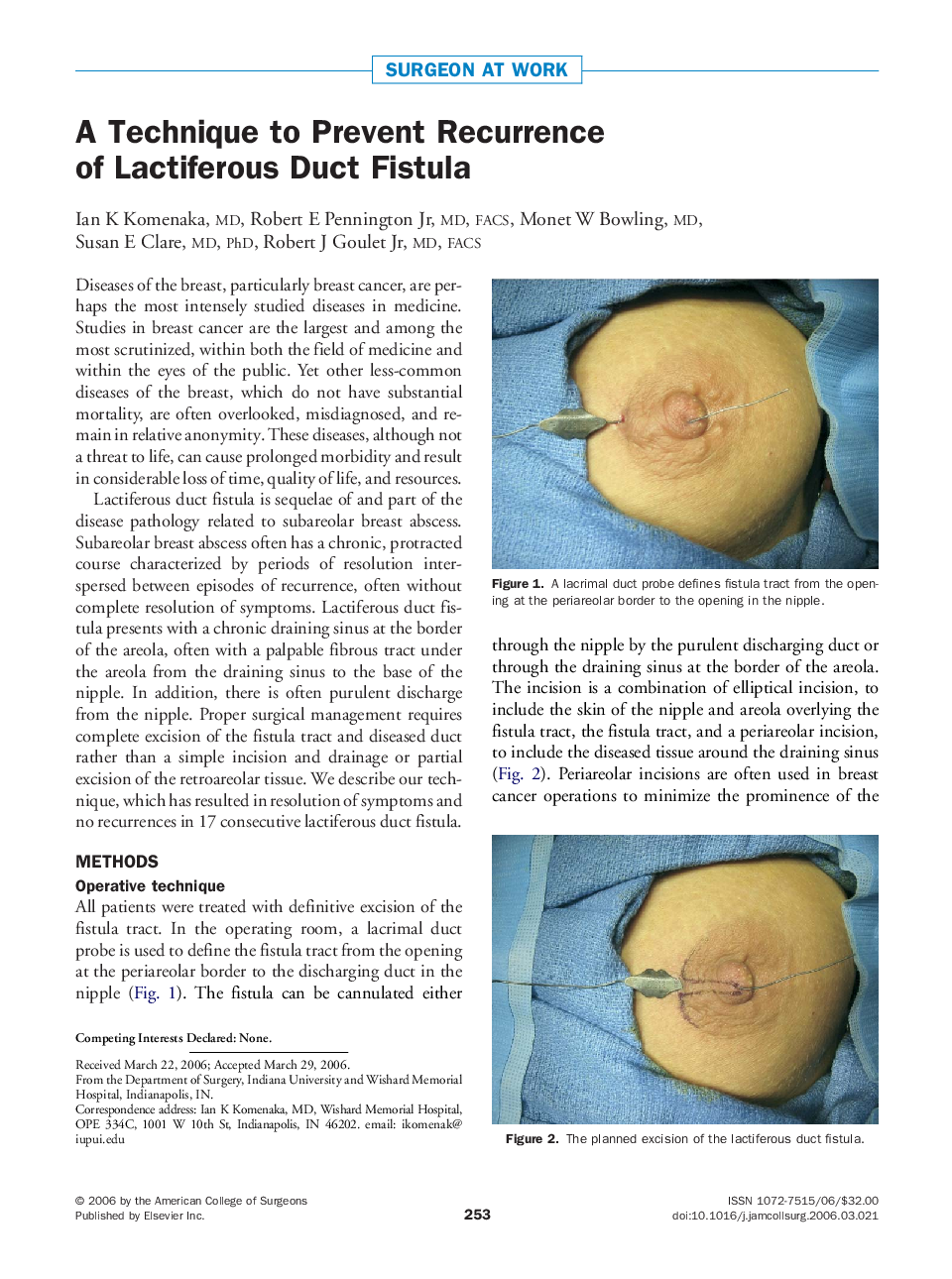 A Technique to Prevent Recurrence of Lactiferous Duct Fistula