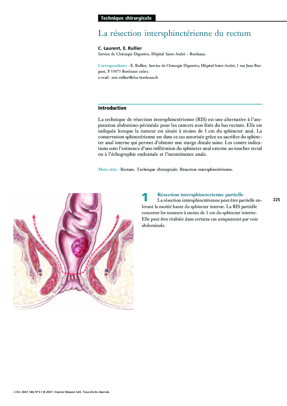 La résection intersphinctérienne du rectum