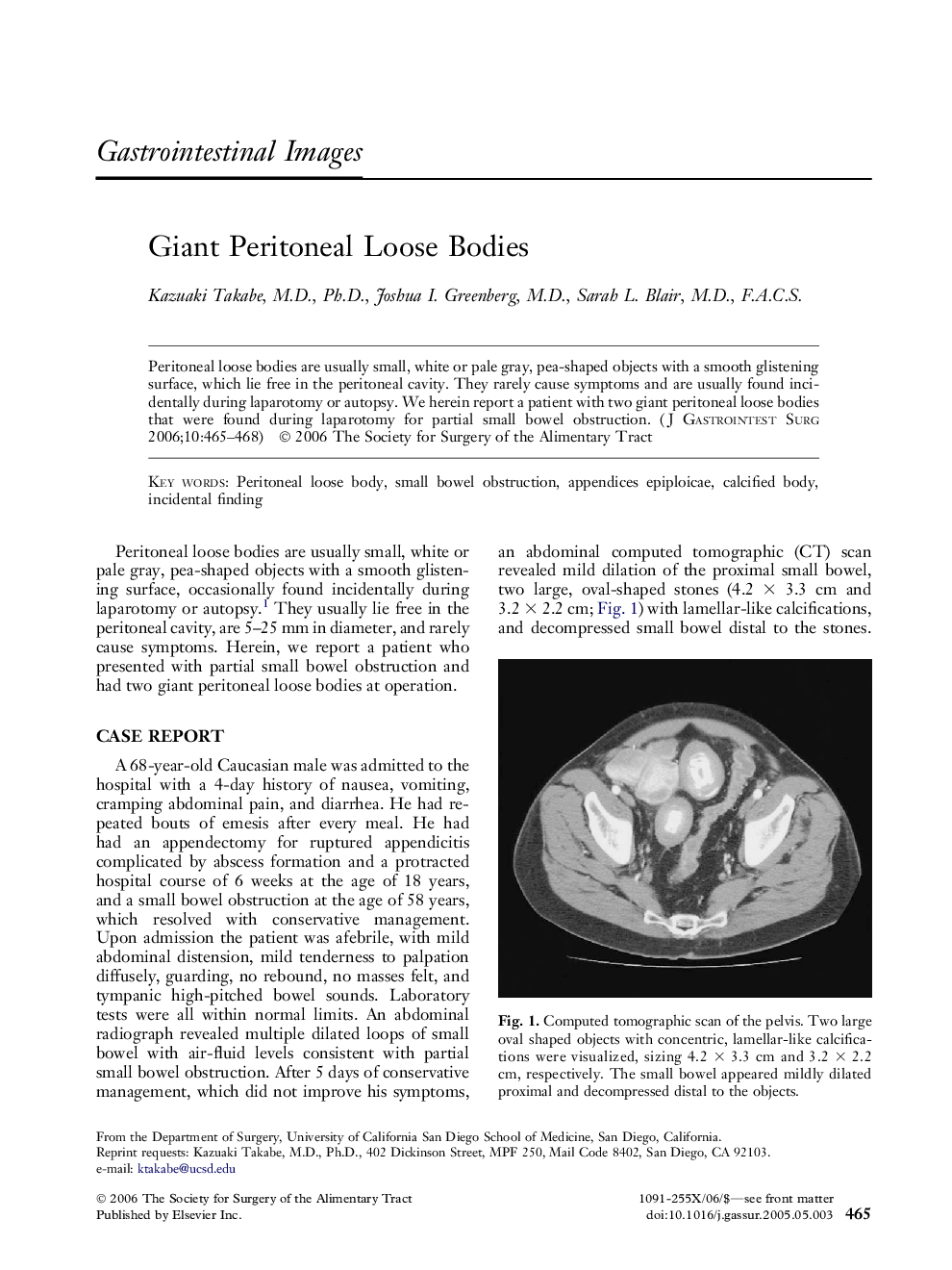 Giant Peritoneal Loose Bodies