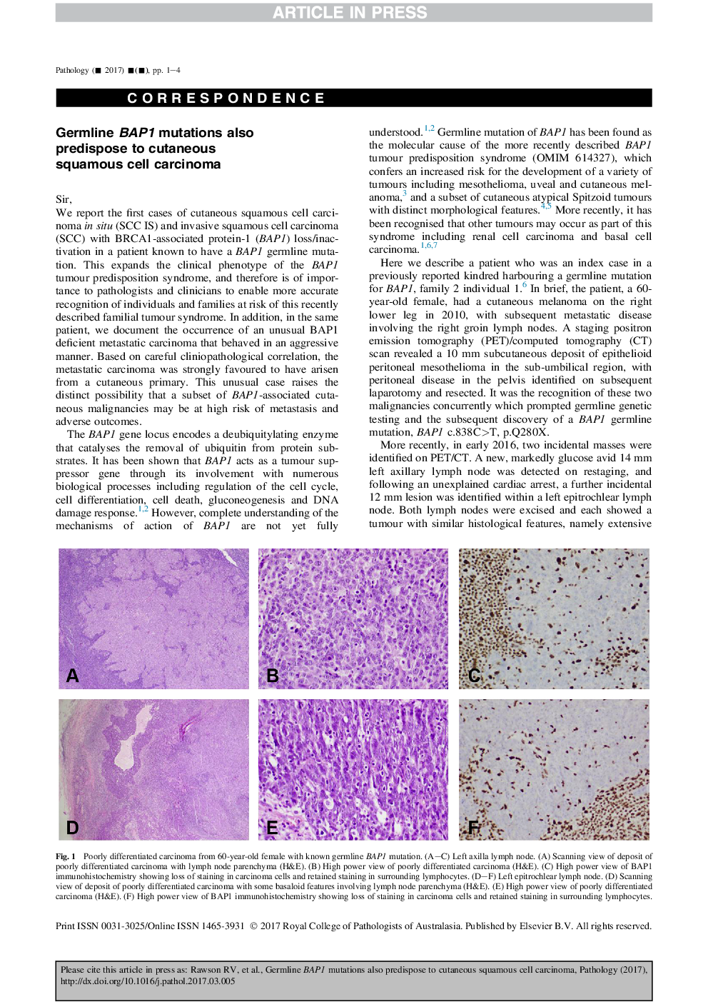 Germline BAP1 mutations also predispose to cutaneous squamous cell carcinoma