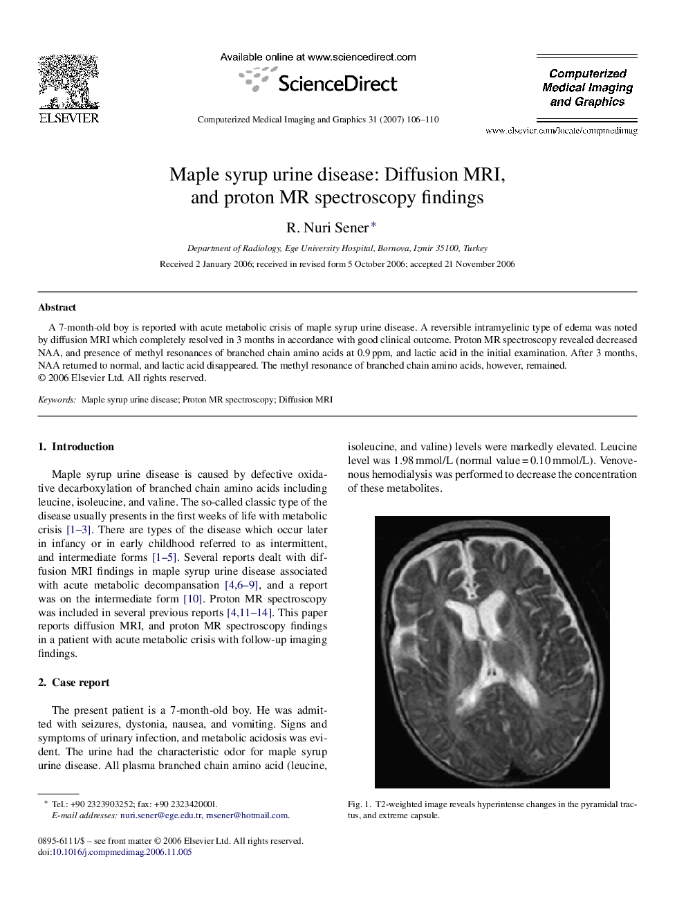 Maple syrup urine disease: Diffusion MRI, and proton MR spectroscopy findings