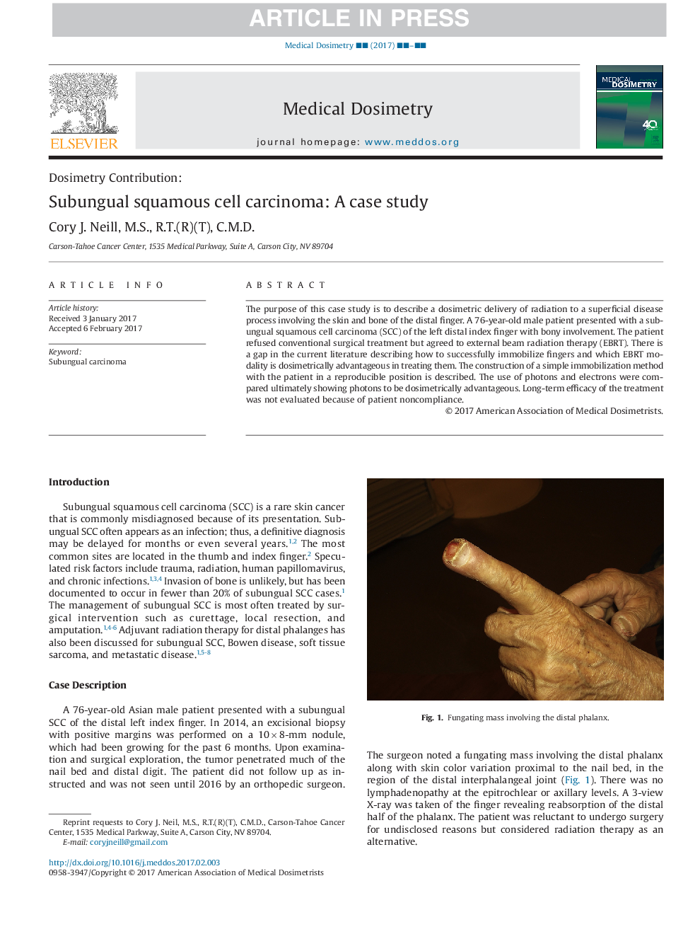 Subungual squamous cell carcinoma: A case study