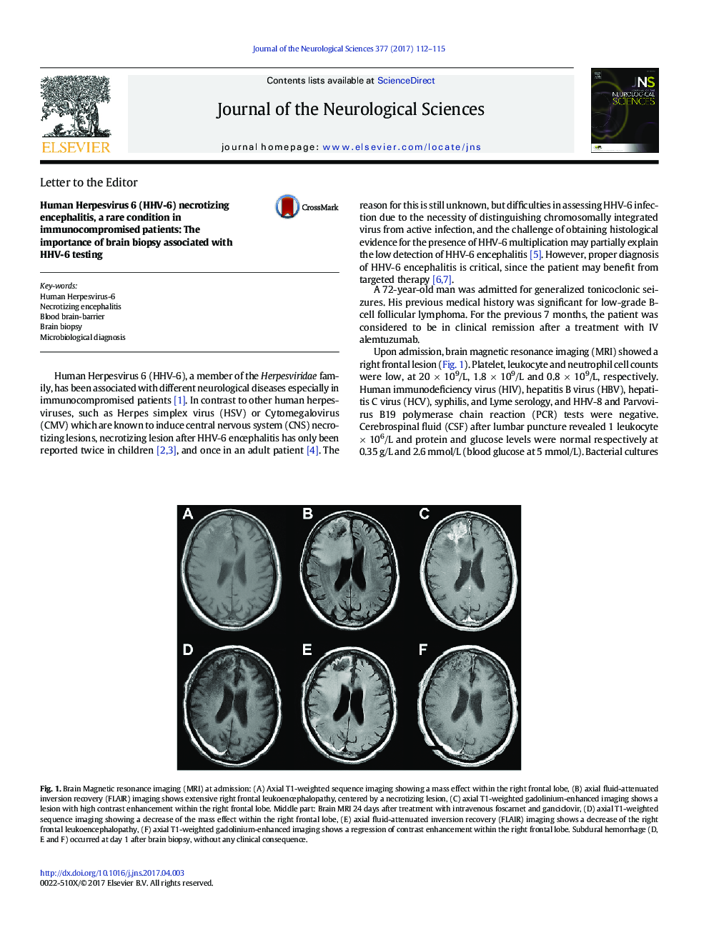 Human Herpesvirus 6 (HHV-6) necrotizing encephalitis, a rare condition in immunocompromised patients: The importance of brain biopsy associated with HHV-6 testing