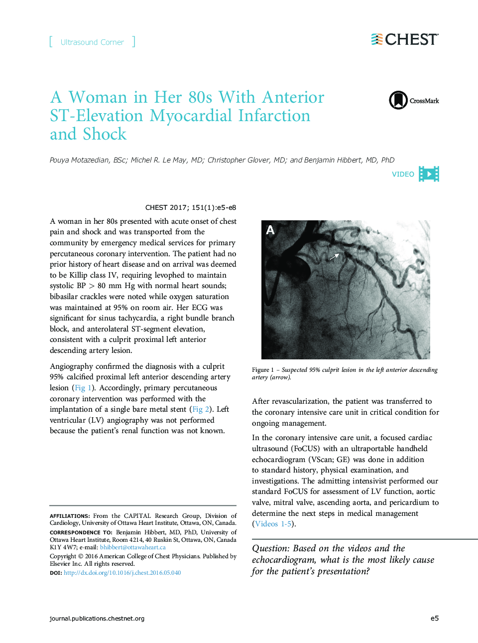 A Woman in Her 80s With Anterior ST-Elevation Myocardial Infarction andÂ Shock