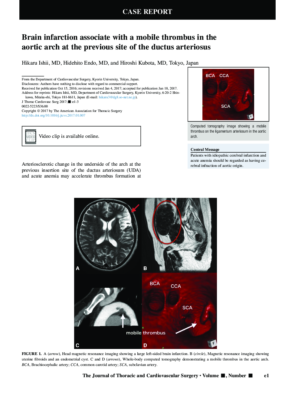 Brain infarction associate with a mobile thrombus in the aortic arch at the previous site of the ductus arteriosus