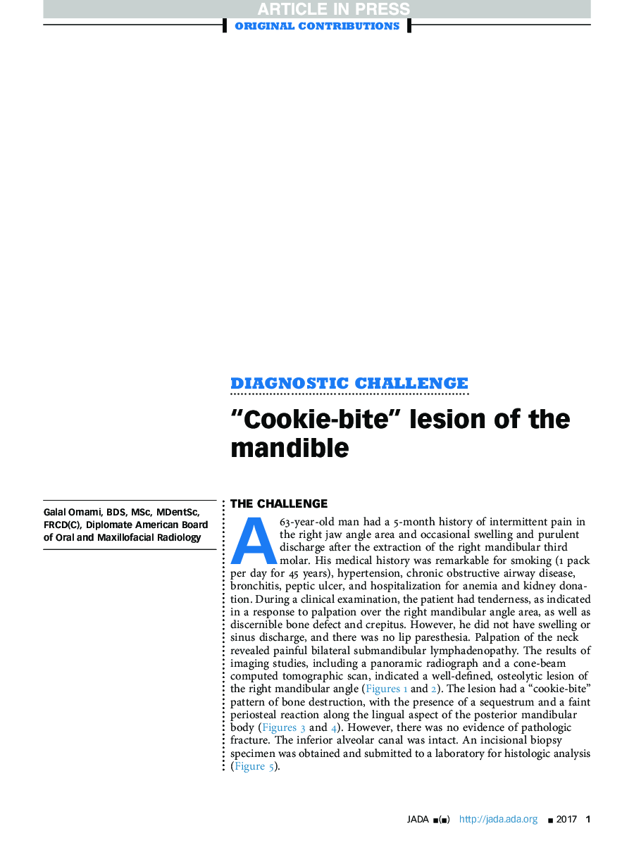 “Cookie-bite” lesion of the mandible