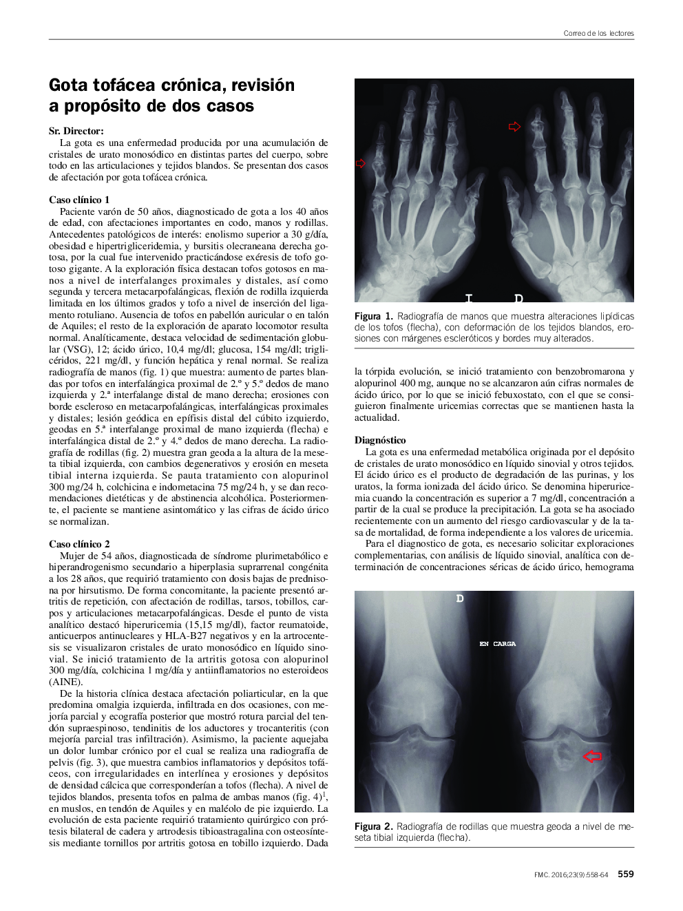 Gota tofácea crónica, revisión a propósito de dos casos