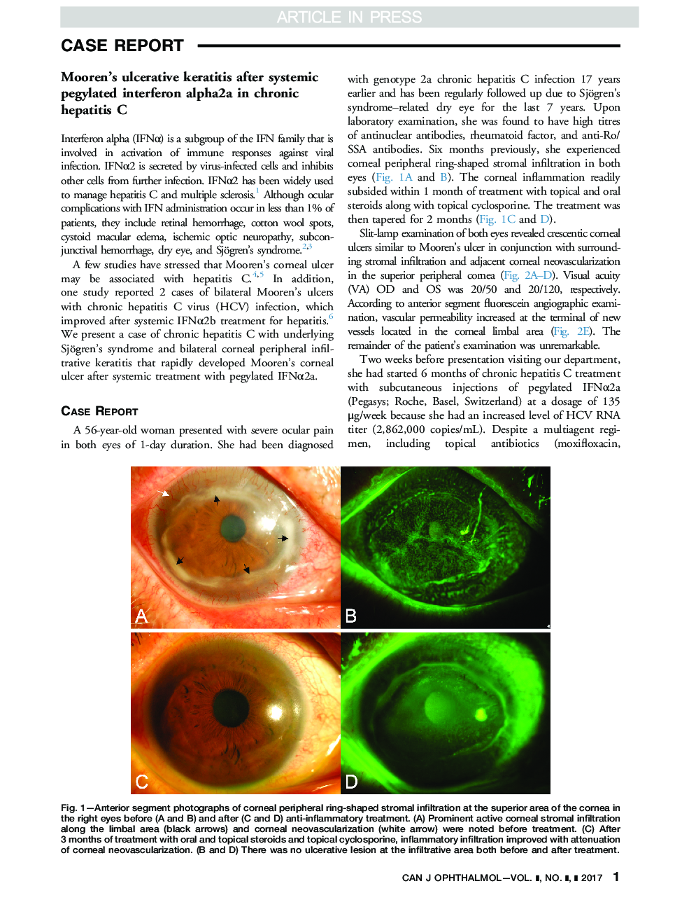 عکس صفحه اول مقاله: Mooren's ulcerative keratitis after systemic pegylated interferon alpha2a in chronic hepatitis C Mooren's ulcerative keratitis after systemic pegylated interferon alpha2a in chronic hepatitis C