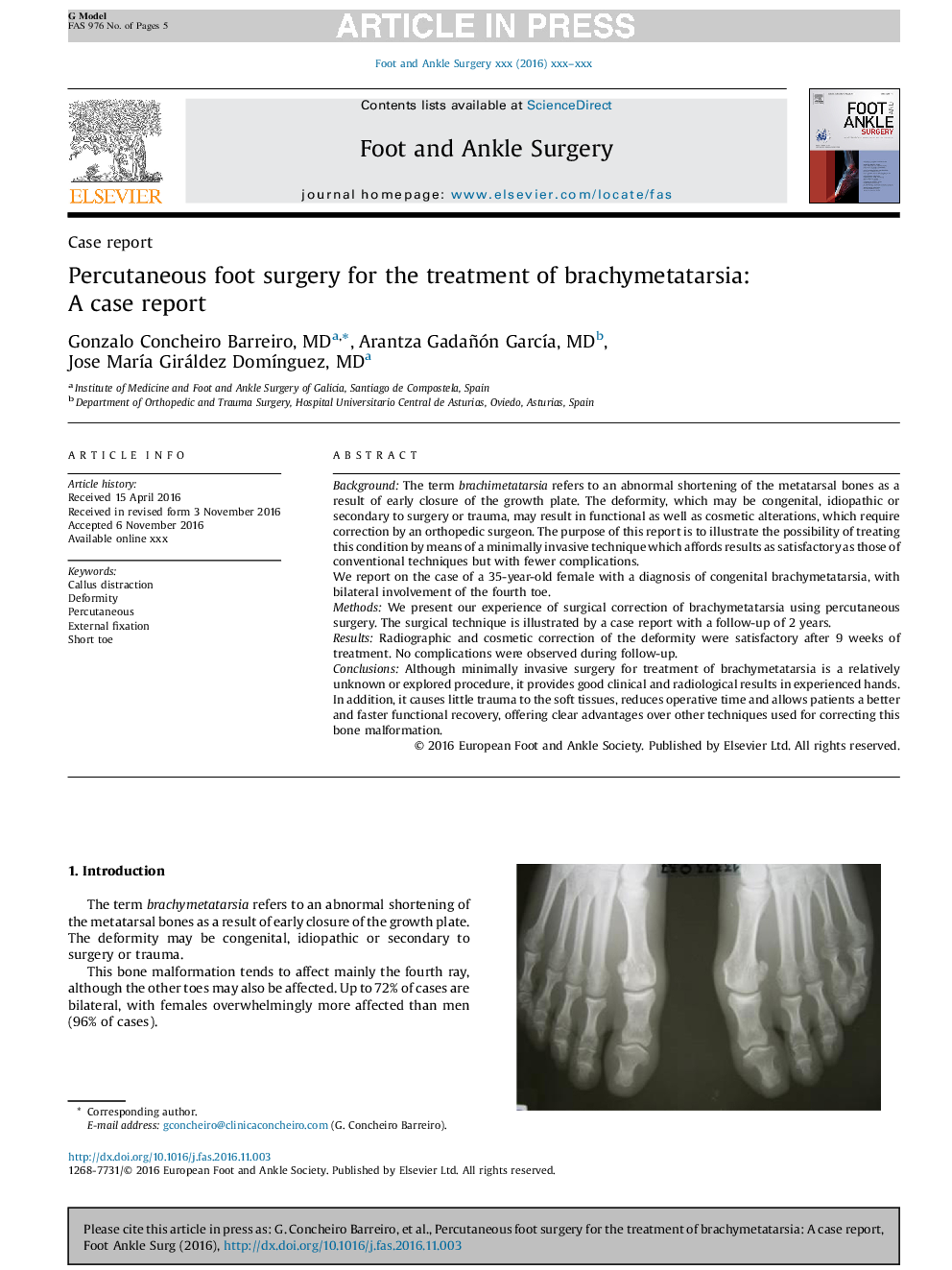 Percutaneous foot surgery for the treatment of brachymetatarsia: A case report