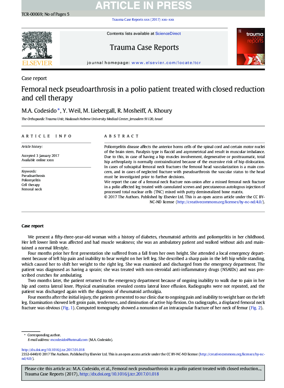 Femoral neck pseudoarthrosis in a polio patient treated with closed reduction and cell therapy