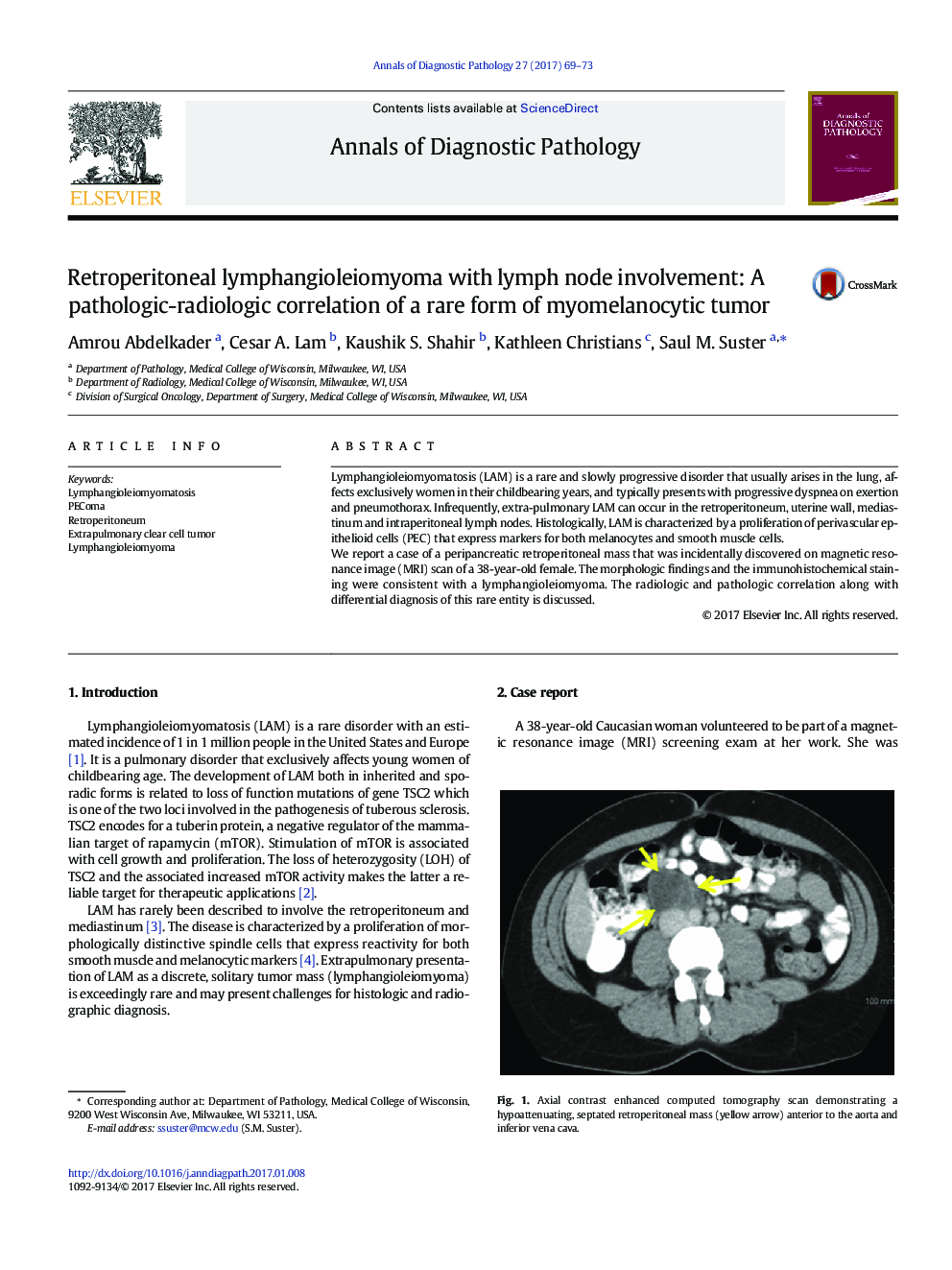 Original ContributionRetroperitoneal lymphangioleiomyoma with lymph node involvement: A pathologic-radiologic correlation of a rare form of myomelanocytic tumor