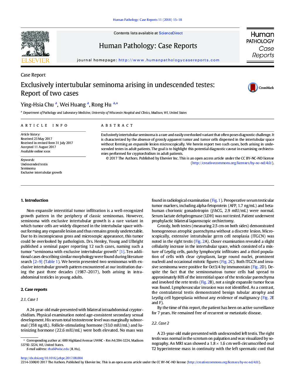 Case ReportExclusively intertubular seminoma arising in undescended testes: Report of two cases