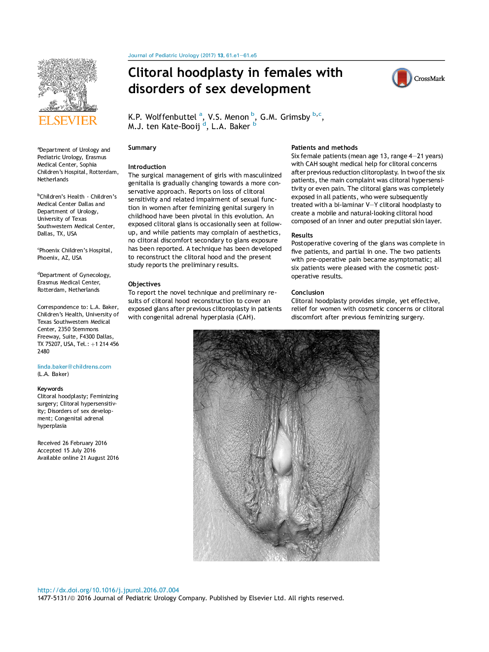 Clitoral hoodplasty in females with disorders of sex development