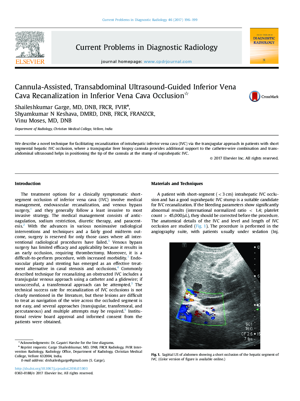 Cannula-Assisted, Transabdominal Ultrasound-Guided Inferior Vena Cava Recanalization in Inferior Vena Cava Occlusion