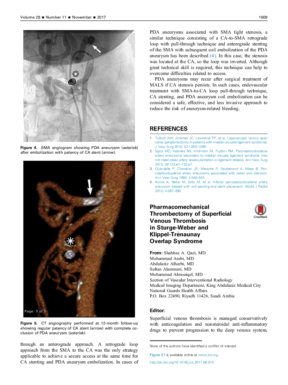 Pharmacomechanical Thrombectomy of Superficial Venous Thrombosis inÂ Sturge-Weber and Klippel-Trénaunay OverlapÂ Syndrome