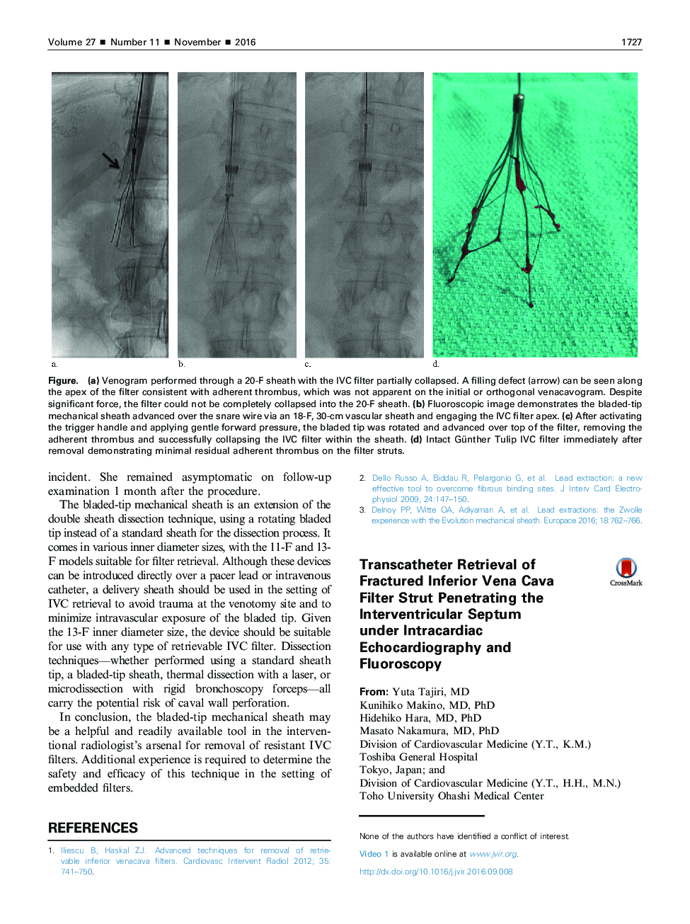 Transcatheter Retrieval of Fractured Inferior Vena Cava Filter Strut Penetrating the Interventricular Septum under Intracardiac Echocardiography and Fluoroscopy