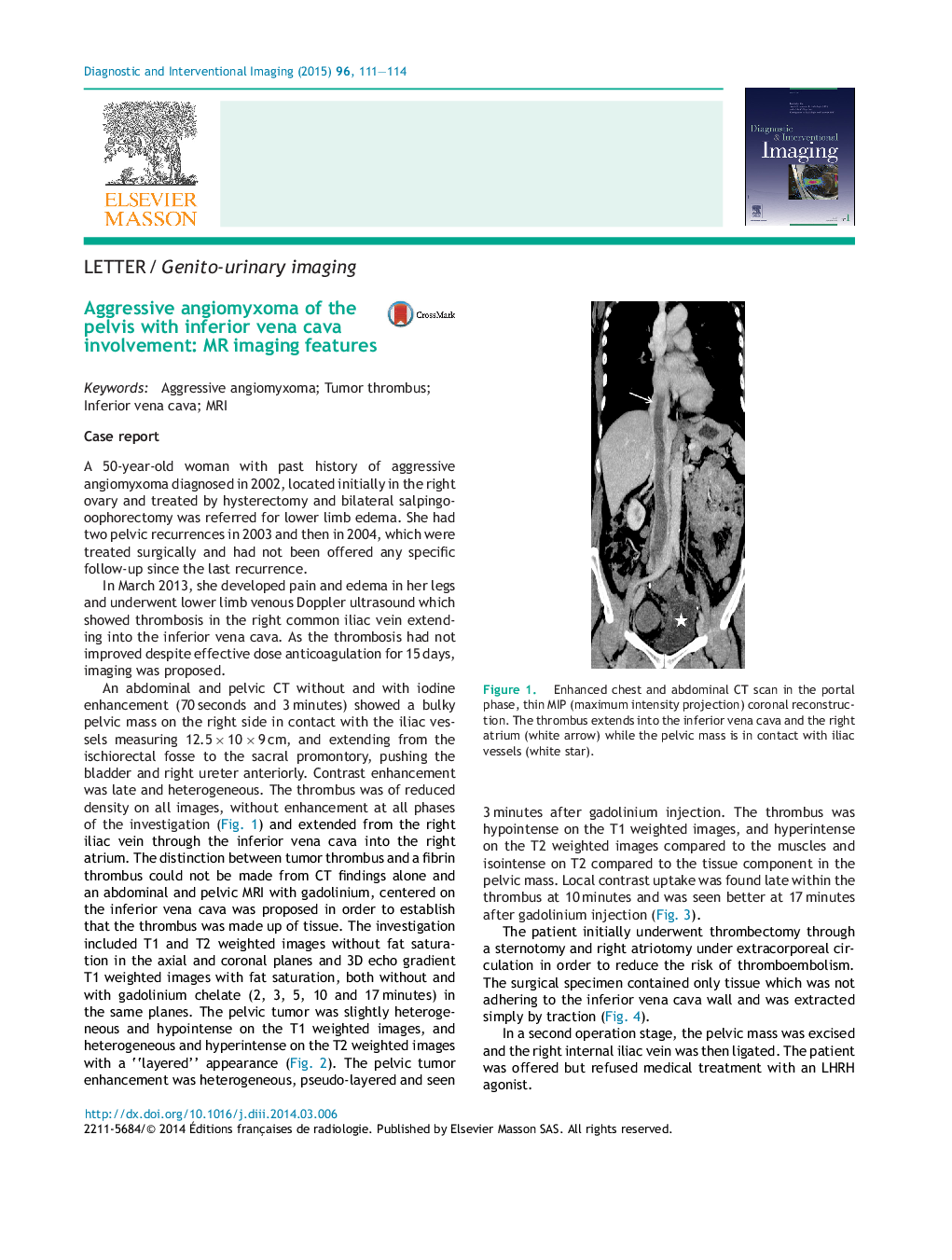 Aggressive angiomyxoma of the pelvis with inferior vena cava involvement: MR imaging features