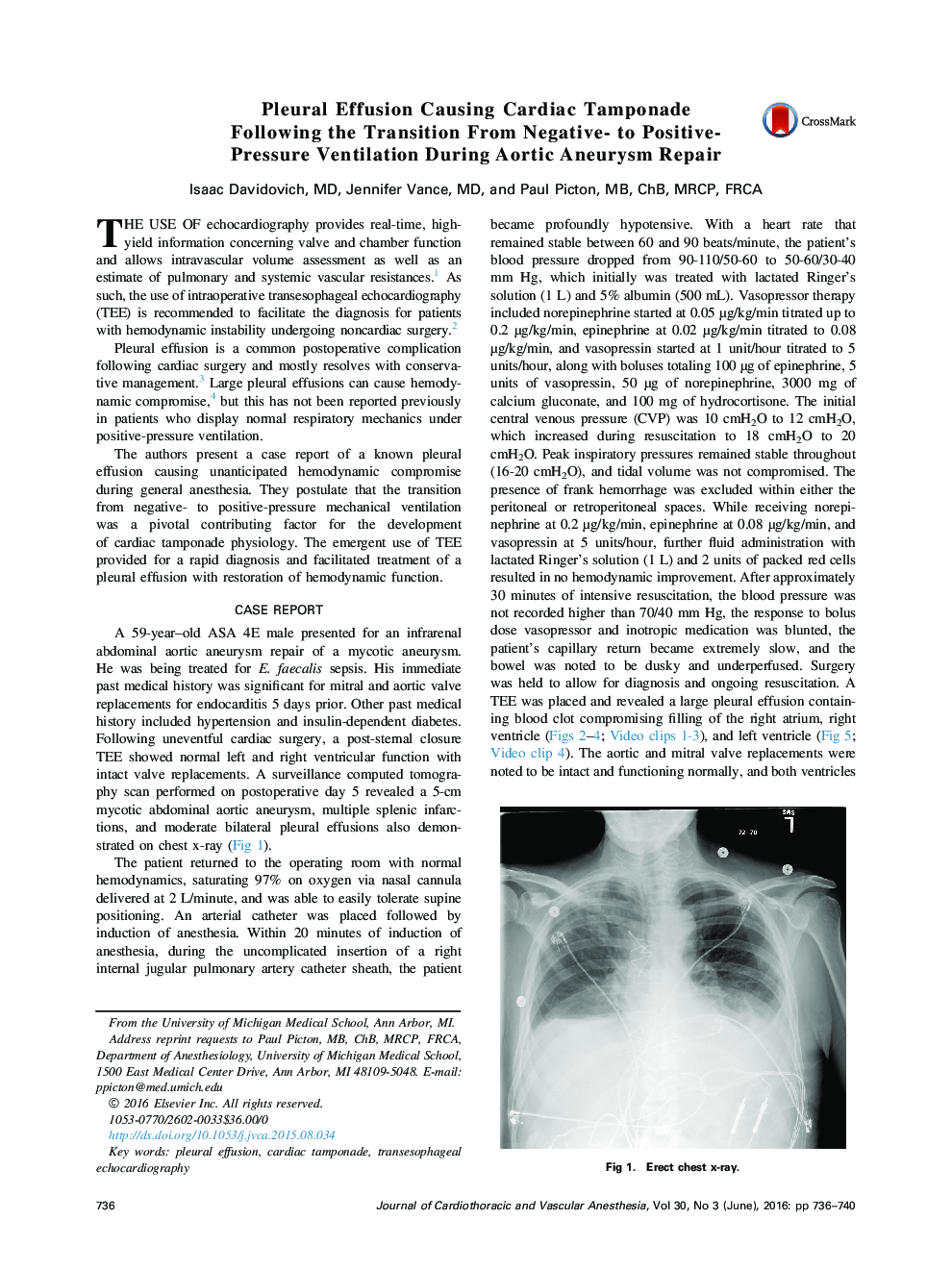 Pleural Effusion Causing Cardiac Tamponade Following the Transition From Negative- to Positive-Pressure Ventilation During Aortic Aneurysm Repair