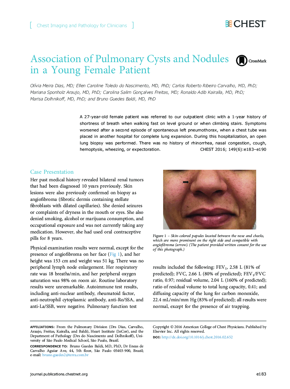Association of Pulmonary Cysts and Nodules in a Young Female Patient