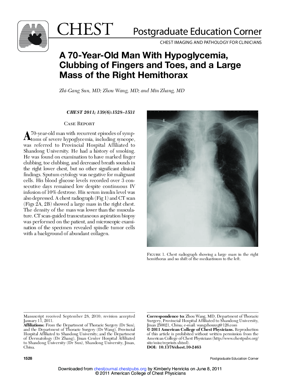 A 70-Year-Old Man With Hypoglycemia, Clubbing of Fingers and Toes, and a Large Mass of the Right Hemithorax