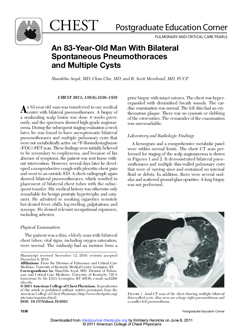 عکس صفحه اول مقاله: An 83-Year-Old Man With Bilateral Spontaneous Pneumothoraces and Multiple Cysts An 83-Year-Old Man With Bilateral Spontaneous Pneumothoraces and Multiple Cysts