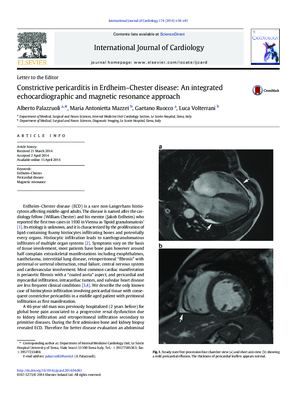 پریکاردیت انسدادی در بیماری اردهام-چستر: رویکرد یکپارچه اکوکاردیوگرافی و رزونانس مغناطیسی 