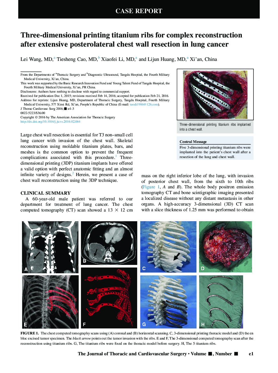 Three-dimensional printing titanium ribs for complex reconstruction after extensive posterolateral chest wall resection in lung cancer