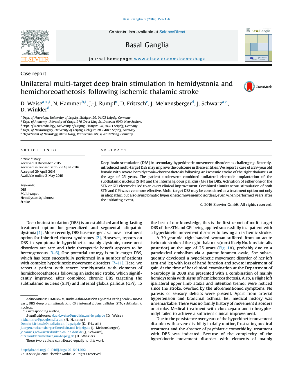 Unilateral multi-target deep brain stimulation in hemidystonia and hemichoreoathetosis following ischemic thalamic stroke