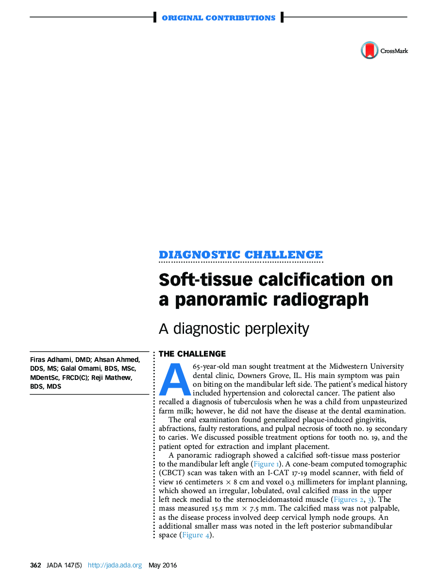 Soft-tissue calcification on a panoramic radiograph