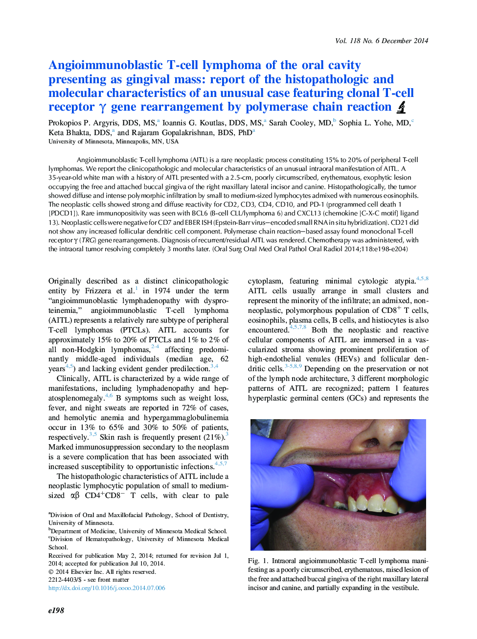 Angioimmunoblastic T-cell lymphoma of the oral cavity presenting as gingival mass: report of the histopathologic and molecular characteristics of an unusual case featuring clonal T-cell receptor Î³ gene rearrangement by polymerase chain reaction
