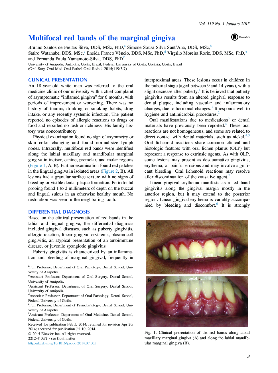 Multifocal red bands of the marginal gingiva