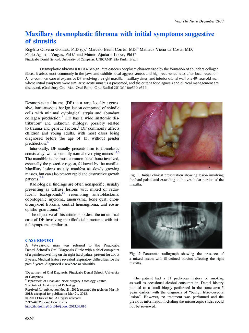 Maxillary desmoplastic fibroma with initial symptoms suggestive of sinusitis