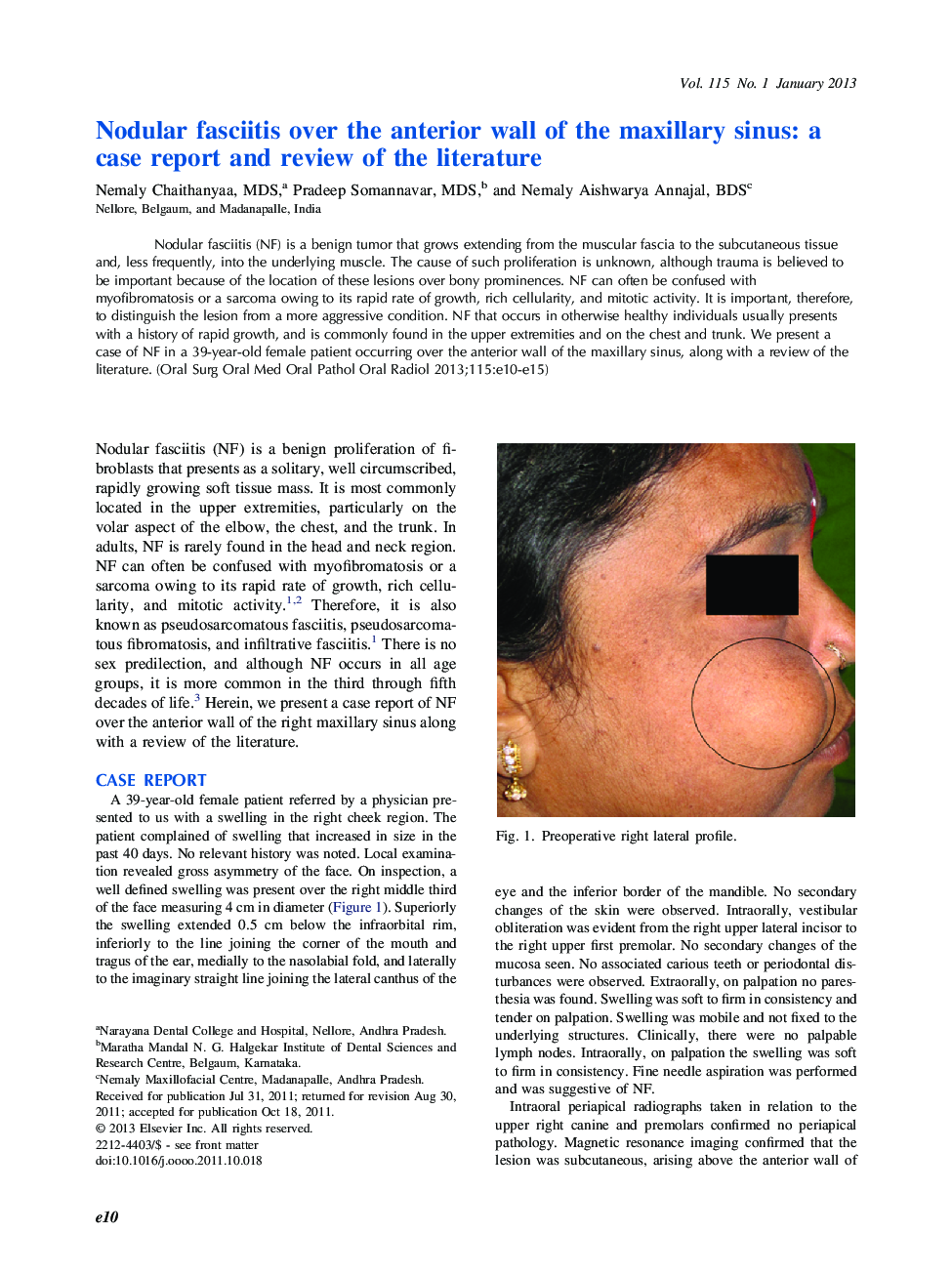 Nodular fasciitis over the anterior wall of the maxillary sinus: a case report and review of the literature