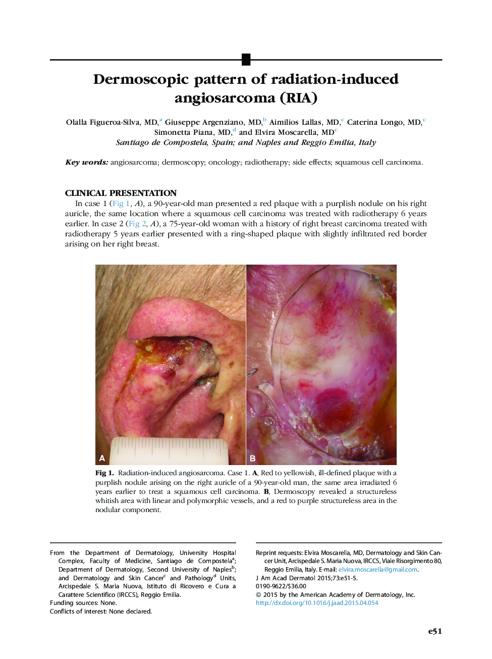 Dermoscopic pattern of radiation-induced angiosarcoma (RIA)