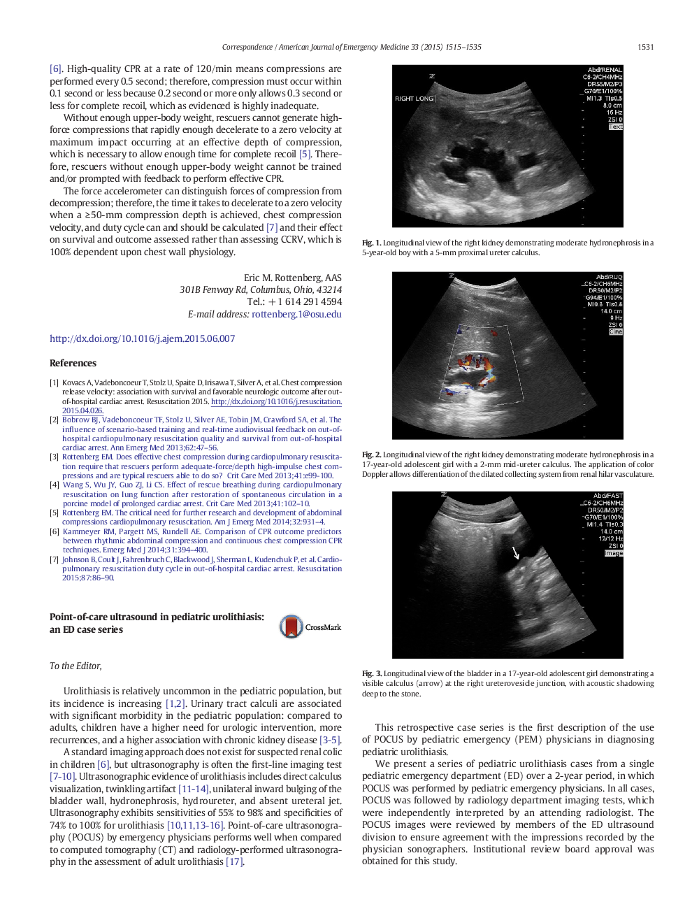 Point-of-care ultrasound in pediatric urolithiasis: an ED case series