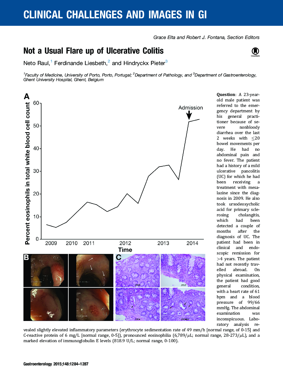 Not a Usual Flare up of Ulcerative Colitis