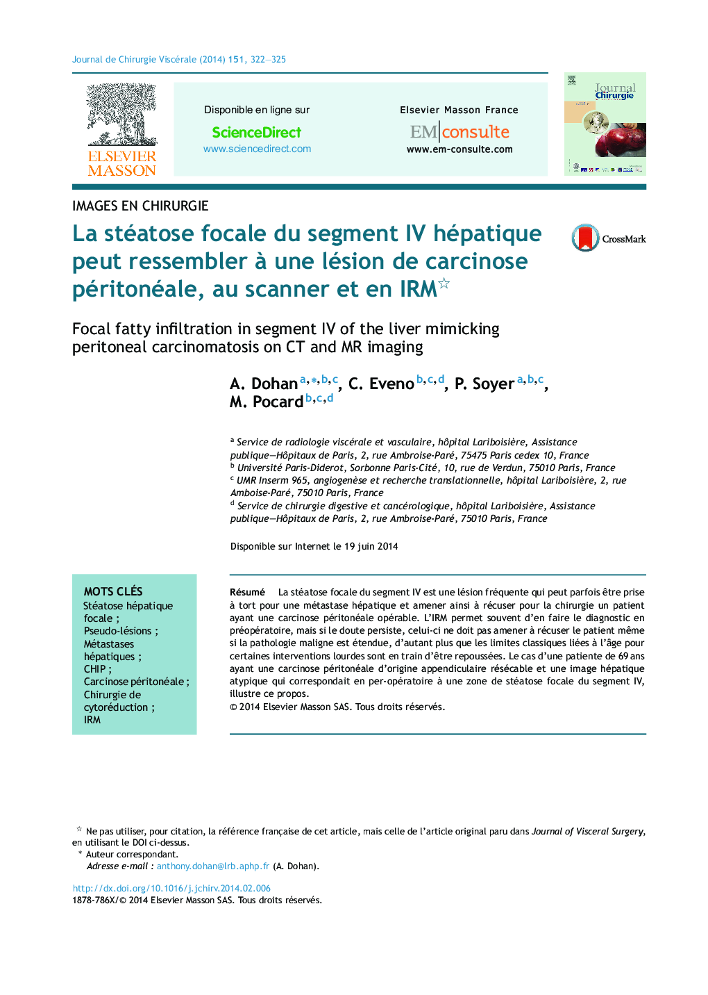 La stéatose focale du segment IV hépatique peut ressembler Ã  une lésion de carcinose péritonéale, au scanner et en IRM