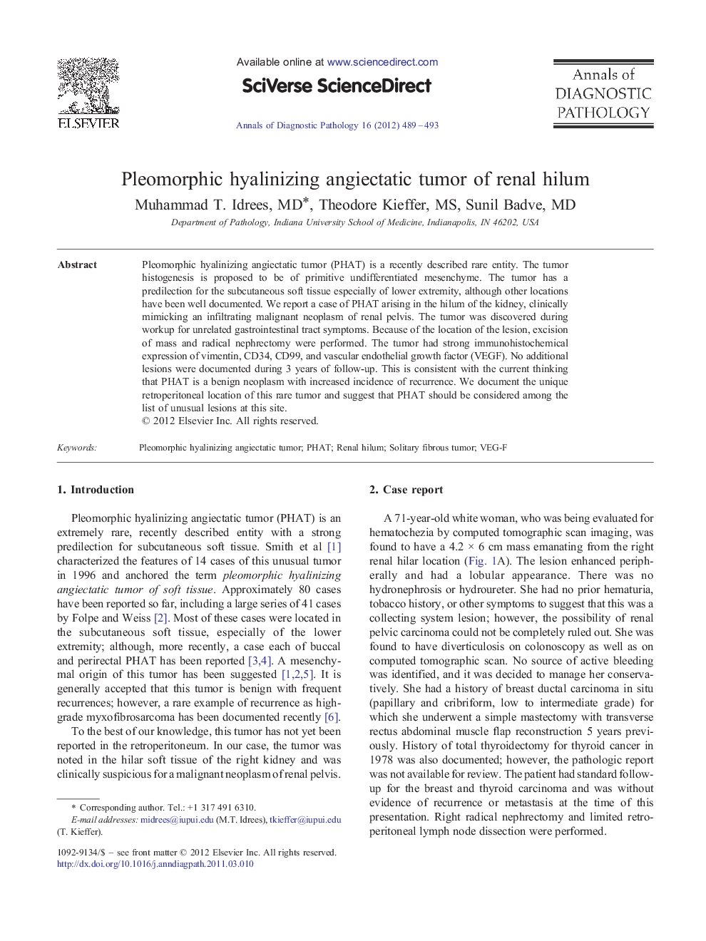 Pleomorphic hyalinizing angiectatic tumor of renal hilum