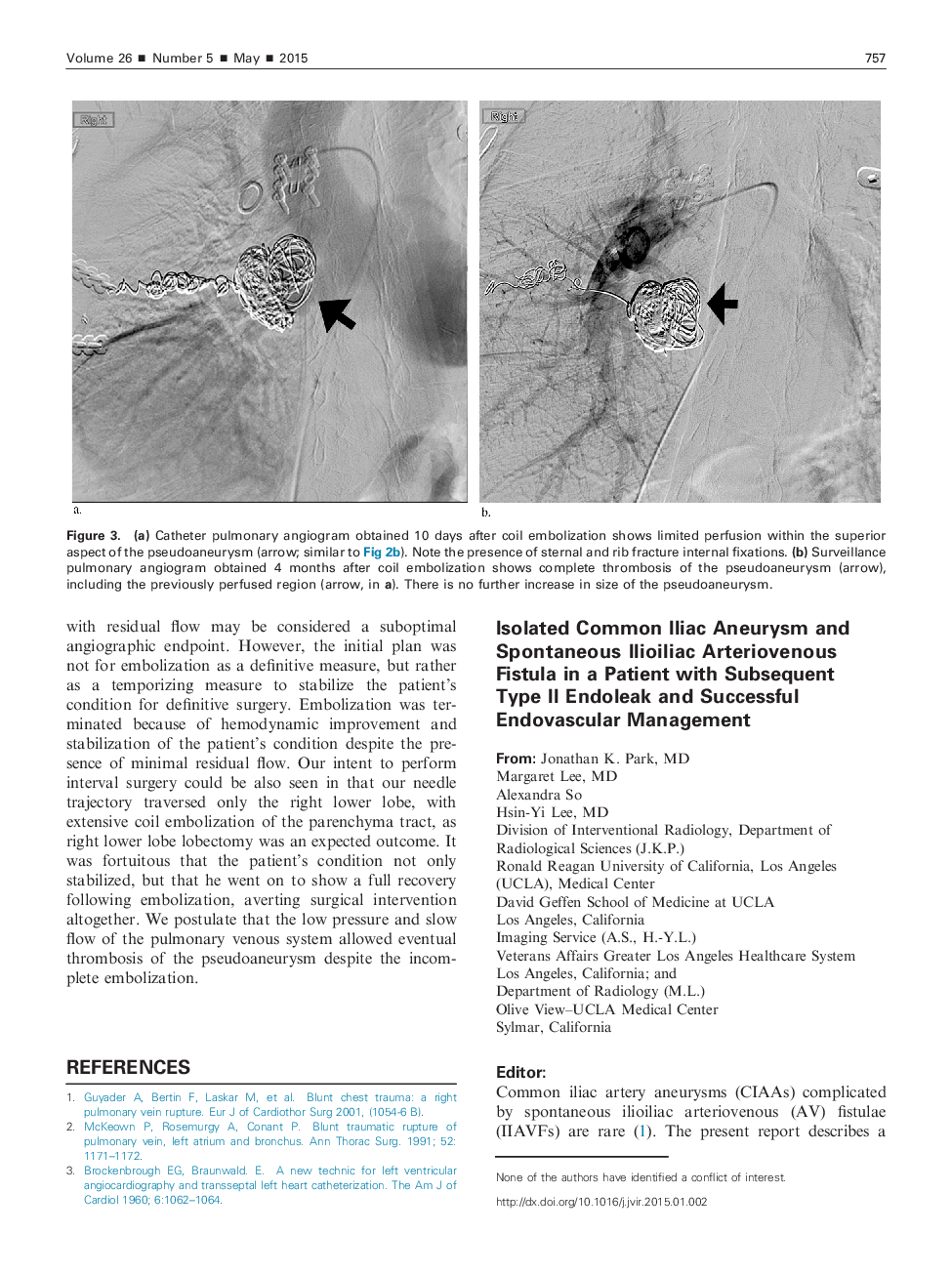 Isolated Common Iliac Aneurysm and Spontaneous Ilioiliac Arteriovenous Fistula in a Patient with Subsequent Type II Endoleak and Successful Endovascular Management