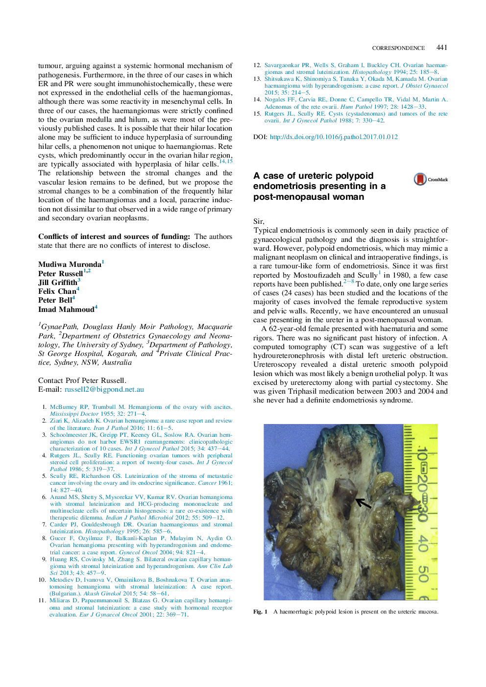 A case of ureteric polypoid endometriosis presenting in a post-menopausal woman