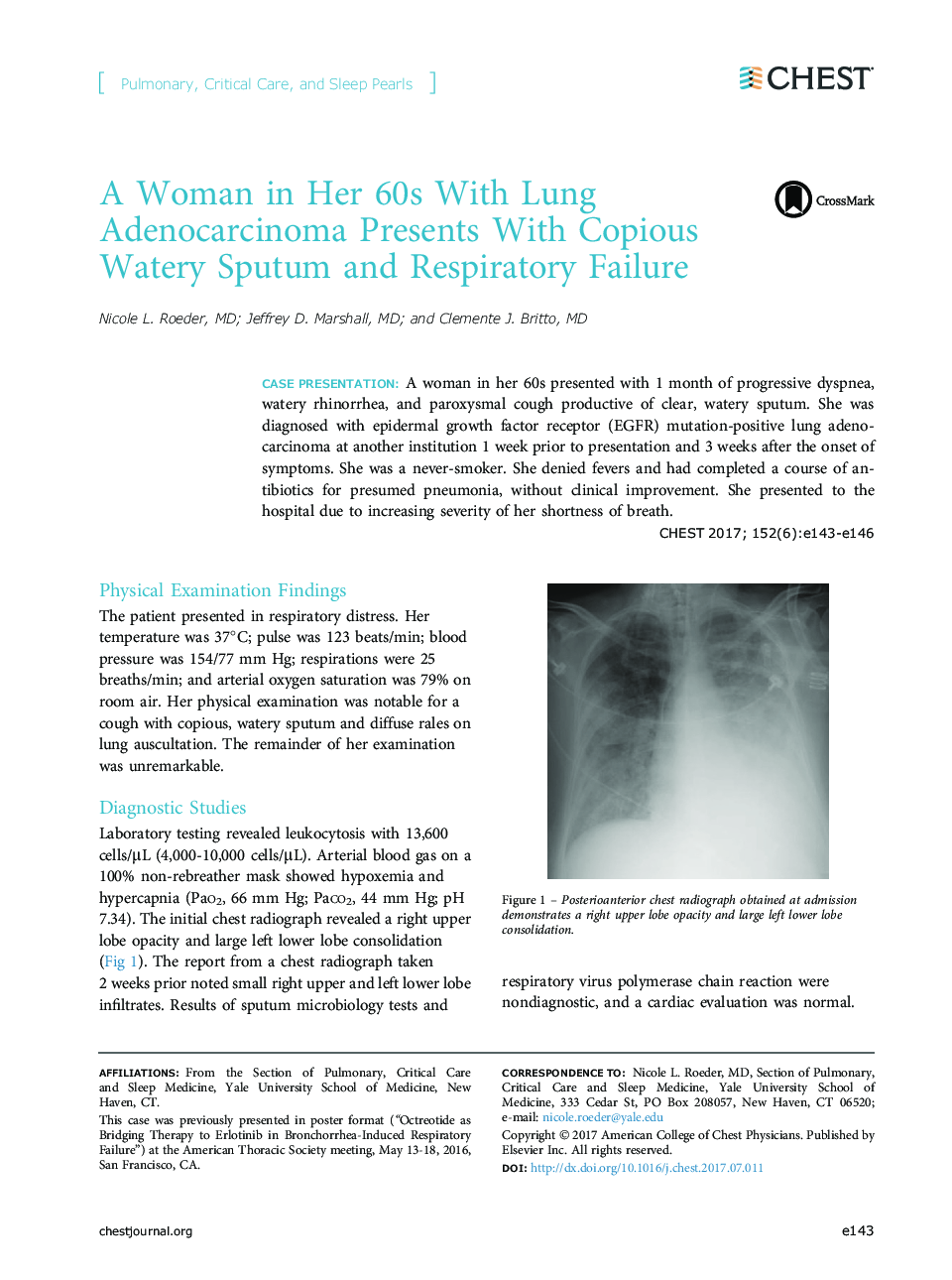 یک زن در 60 سالگی با آدنوکارسینوم ریه با خلط آبدار و نارسایی تنفسی 