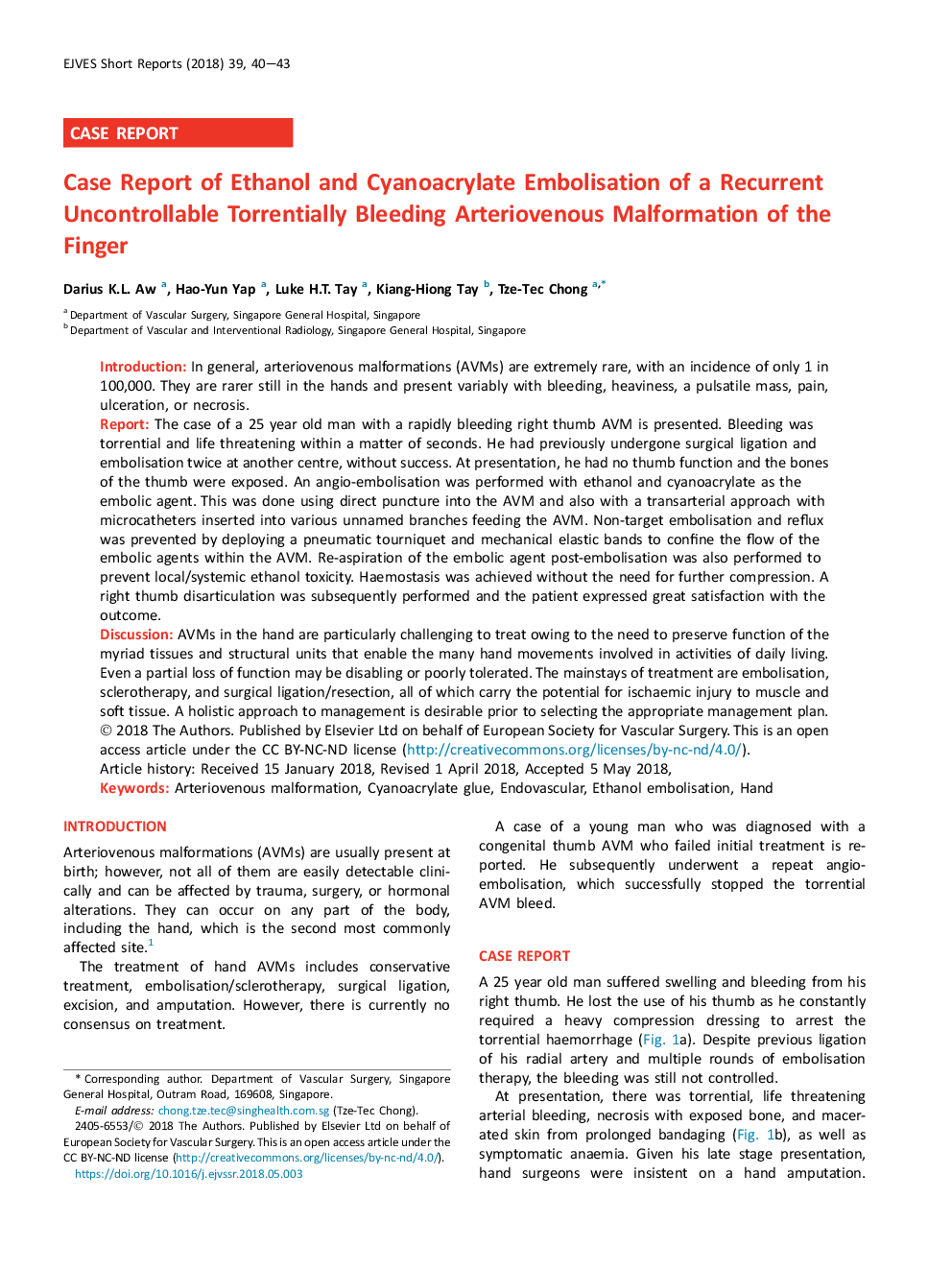 Case Report of Ethanol and Cyanoacrylate Embolisation of a Recurrent Uncontrollable Torrentially Bleeding Arteriovenous Malformation of the Finger