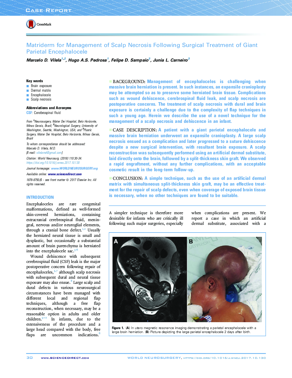 Matriderm for Management of Scalp Necrosis Following Surgical Treatment of Giant Parietal Encephalocele